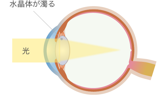 白内障の水晶体