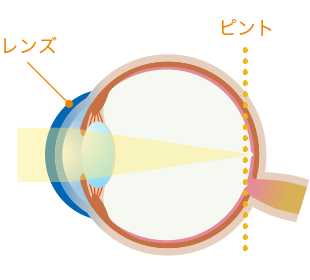 白内障の水晶体