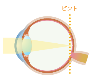 白内障の水晶体